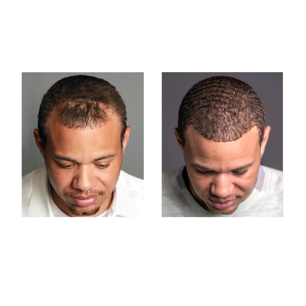 Benefits of Visiting a Hair Loss Treatment Center